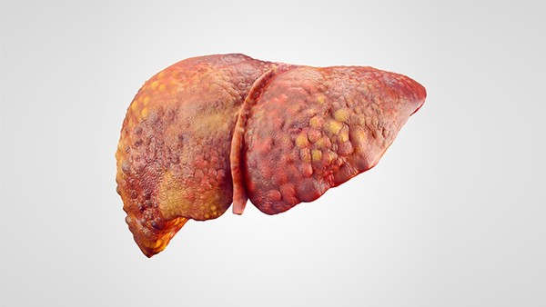<strong>脂肪肝会导致肝癌吗？如何预防脂肪肝？</strong>